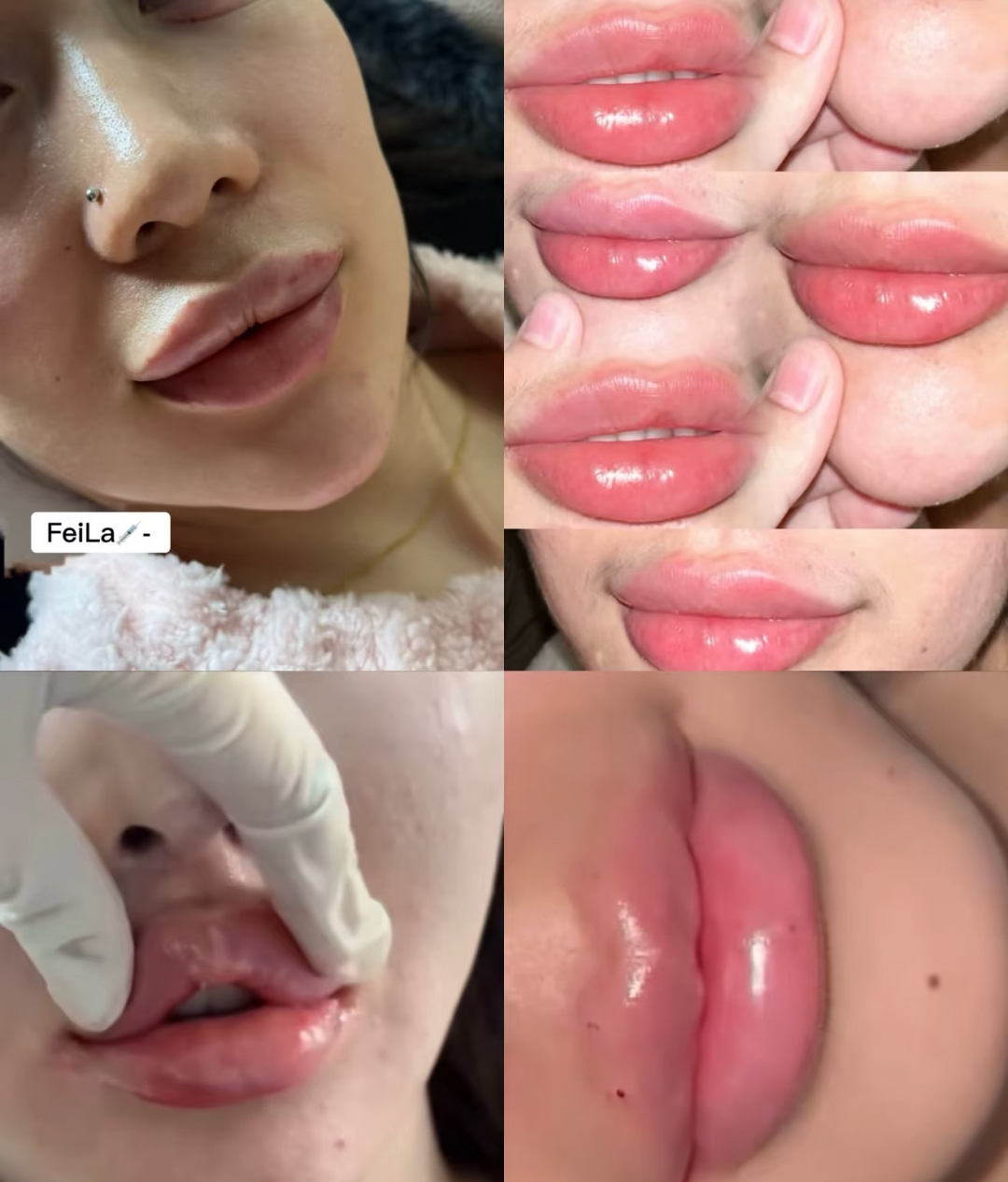 ✨ 30‑min lip filler by West Lake, Hangzhou 💉 Get that